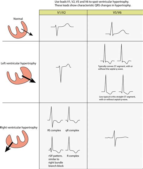 lv too|lv hypertrophy management.